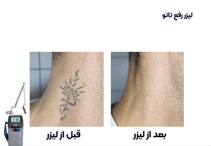 ریمو تتو با لیزر