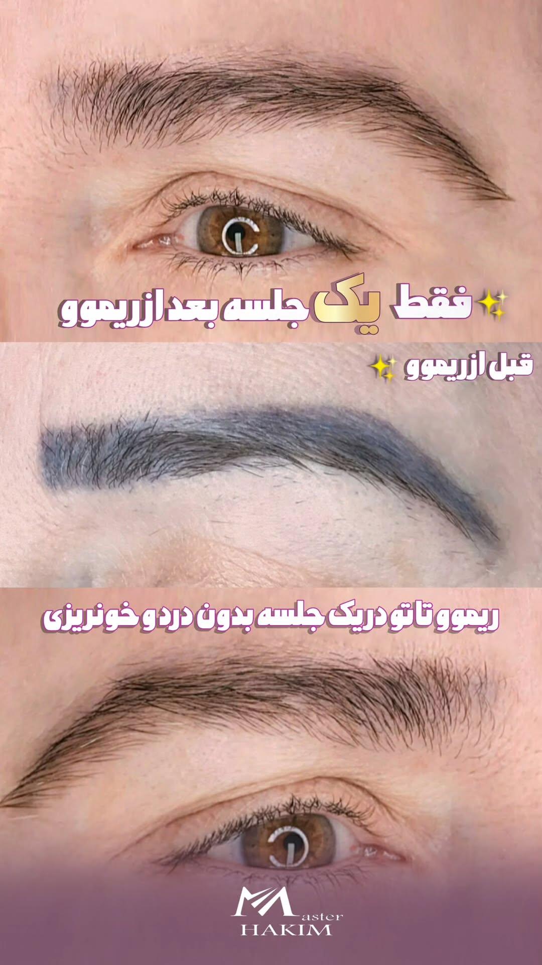ریموو تاتو