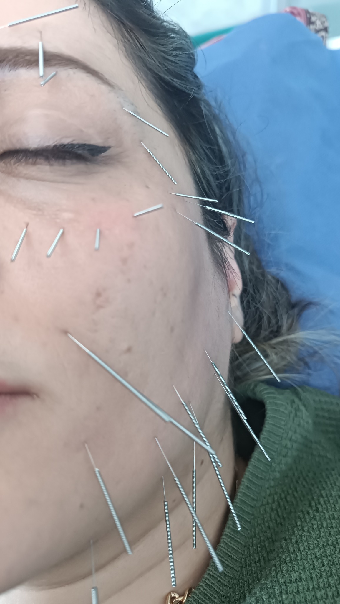 طب درمانی و زیبایی سوزنی نشاط