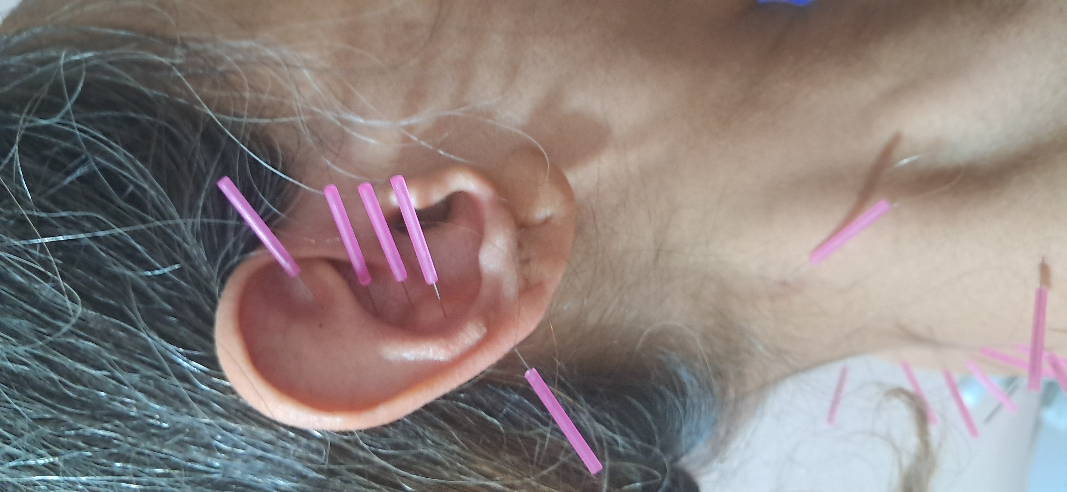 طب سوزنی شهرزاد