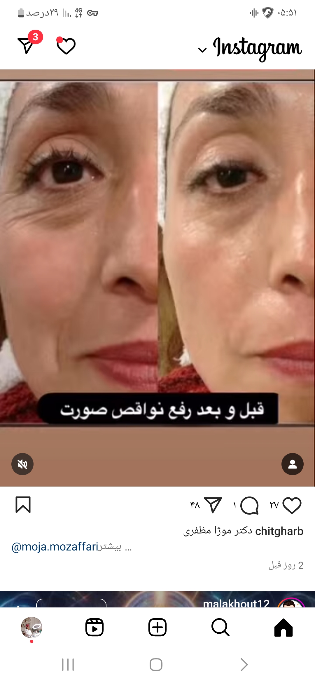 طب سوزنی مهنور