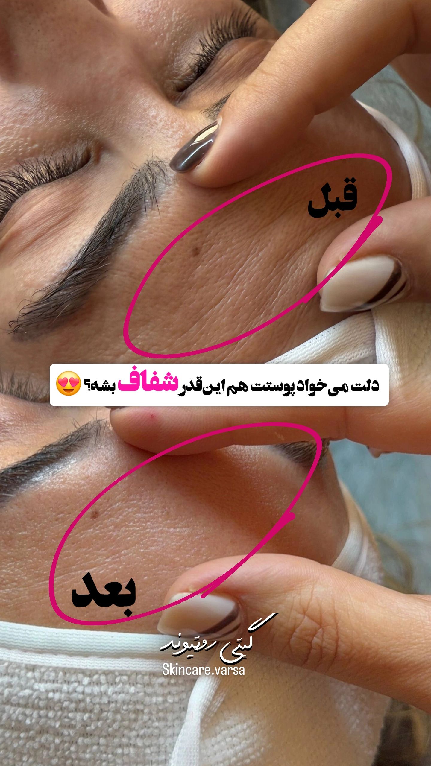 فشیال و پاکسازی پوست ورسا