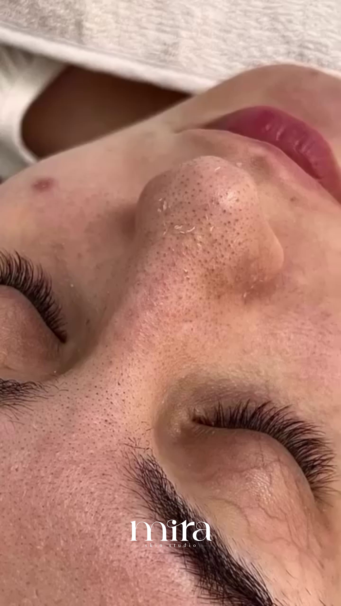 فیشال تخصصی و جوانسازی میرا