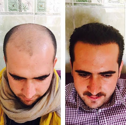 مرکز کاشت موی آتیه یزد