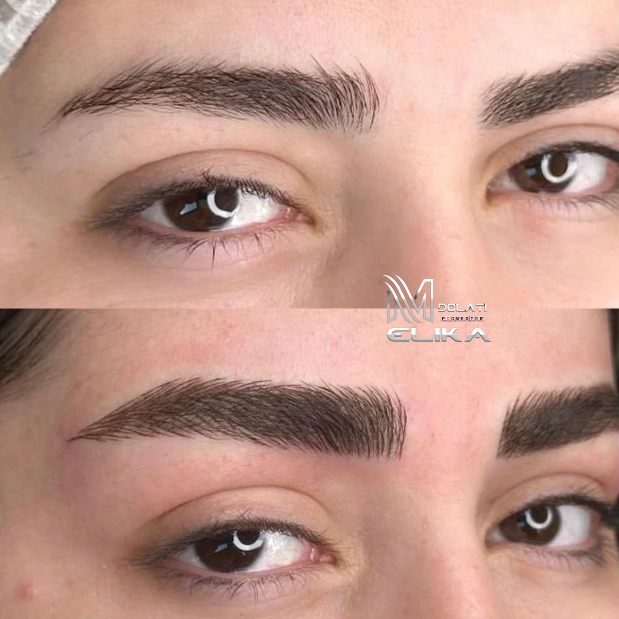 میکروبلیدینگ ملیکادولتی