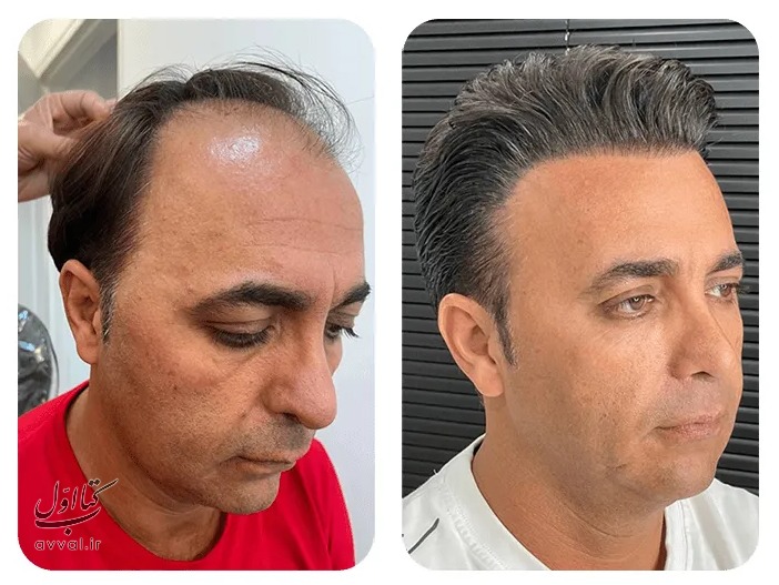 کلینیک کاشت مو اورامان